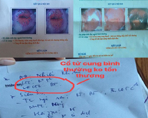Hình ảnh viêm lộ tuyến cổ tử cung của chị Phượng trước và sau khi kết thúc điều trị với bác sĩ Thanh Hà
