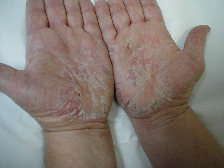 Bệnh á sừng (Dermatitis plantaris sicca) là một thể viêm da cơ địa dị ứng mãn tính, dễ tái phát
