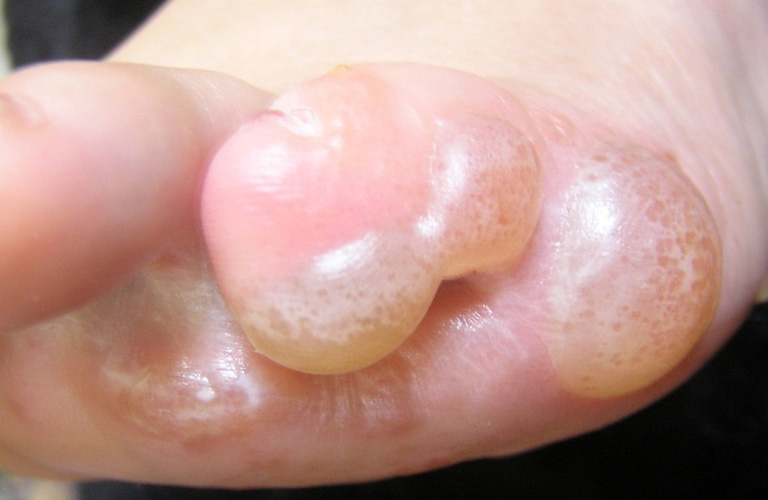 Bệnh tổ đỉa có thể gây biến dạng ngón chân