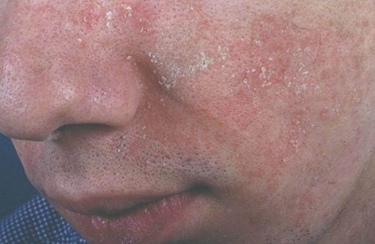 Viêm da tiết bã (hay viêm da dầu) là một bệnh da liễu mãn tính, dễ tái phát