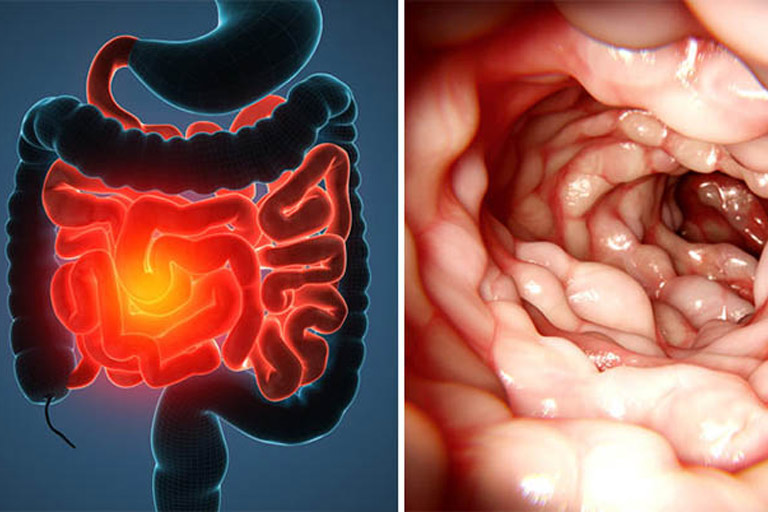 Vảy nến biến chứng có thể gây nên bệnh Crohn