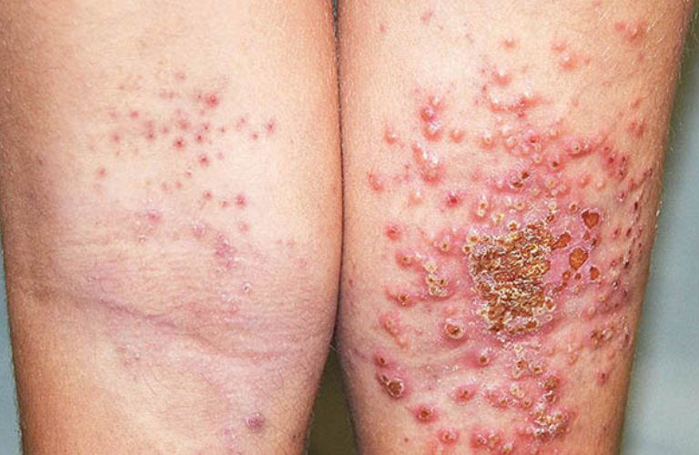 Làn da dễ bị nhiễm trùng nếu bệnh viêm da không được chữa trị nhanh chóng