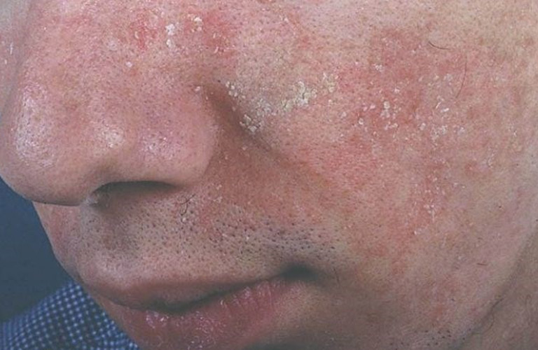 Viêm da tiết bã ở mặt còn gọi là viêm da dầu ở mặt