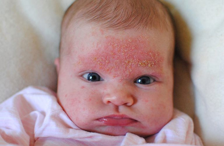 Trẻ sơ sinh là đối tượng dễ bị viêm da tiết bã ở mặt