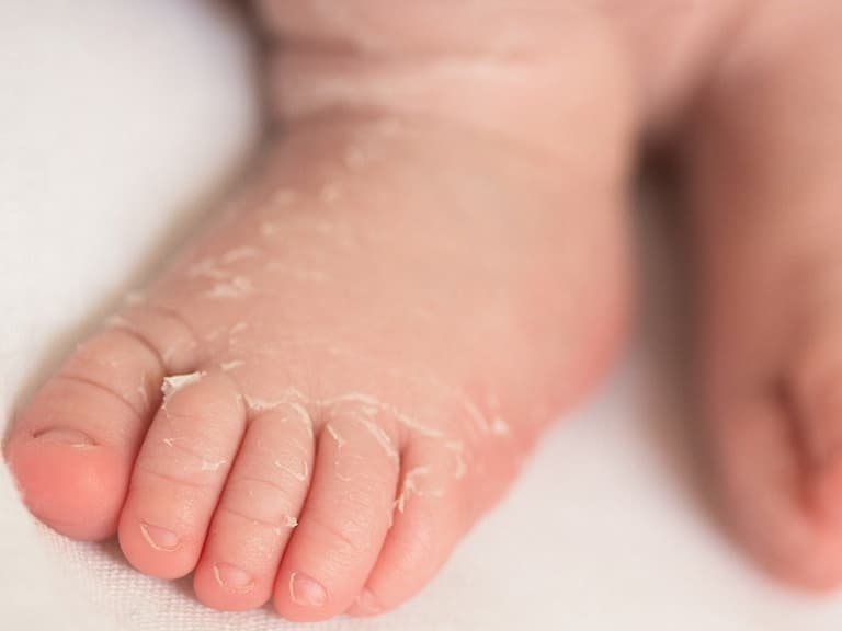 Da khô nứt nẻ ở bàn chân là những dấu hiệu đầu tiên của bệnh á sừng ở trẻ 