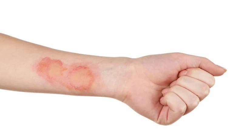 Những dấu hiệu đầu tiên của nhiễm trùng da nếu kéo dài bệnh vảy nến nhẹ 