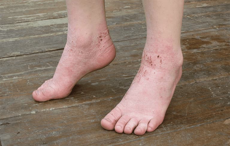 Những vết gãi ngứa rướm máu ở chân 