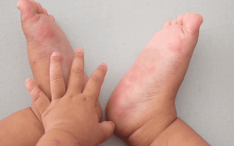 Những mẩn đỏ nổi ở lòng bàn tay và bàn chân của bé 
