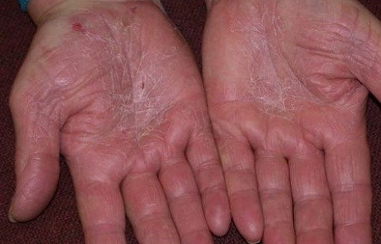 Lòng bàn tay khô ráp và nứt nẻ là những triệu chứng ban đầu của bệnh 