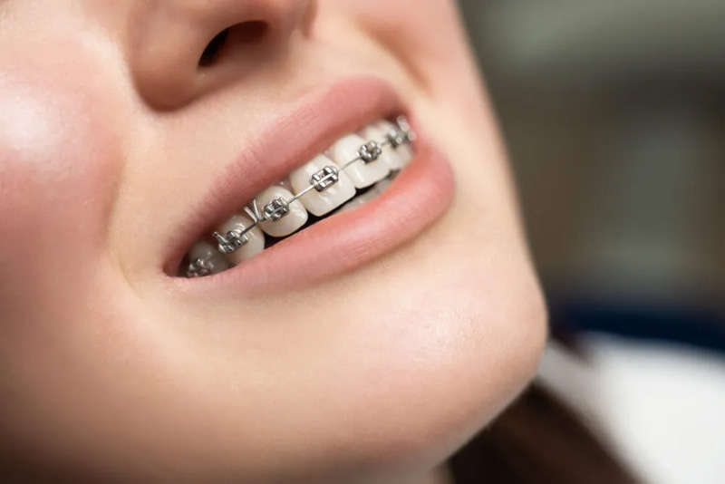 Niềng răng là phương pháp mang đến hiệu quả cao