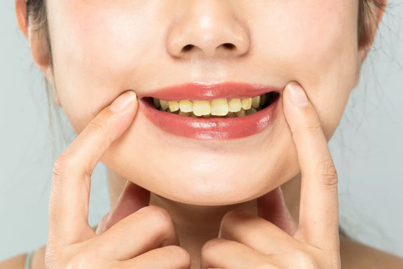 Khi răng bị xỉn màu, bọc răng sứ sẽ là biện pháp hiệu quả