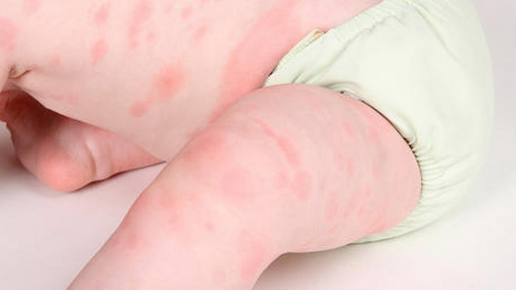 Bé nổi mẩn đỏ khắp người sau sốt là bệnh gì?