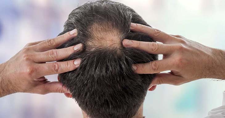 Thuốc chống rụng tóc ảnh hưởng trực tiếp đến sinh lý nam giới