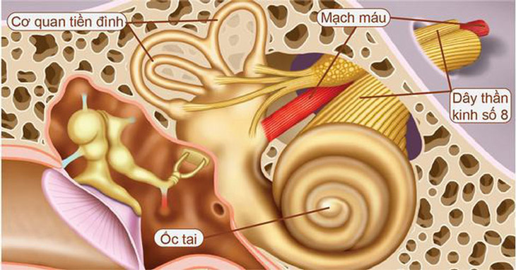 Rối loạn tiền đình ốc tai là gì
