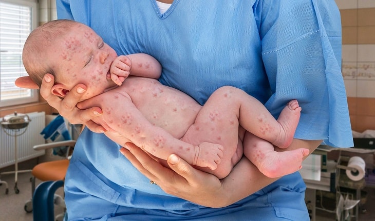 Hình ảnh trẻ sơ sinh bị bệnh sởi nổi mẩn đỏ khắp người, gồm cả chân và tay