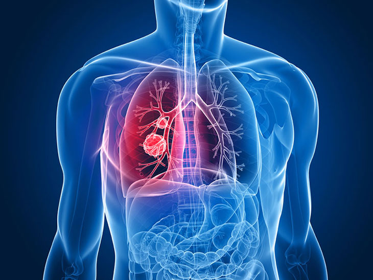 Ung thư đại tràng di căn đến phổi