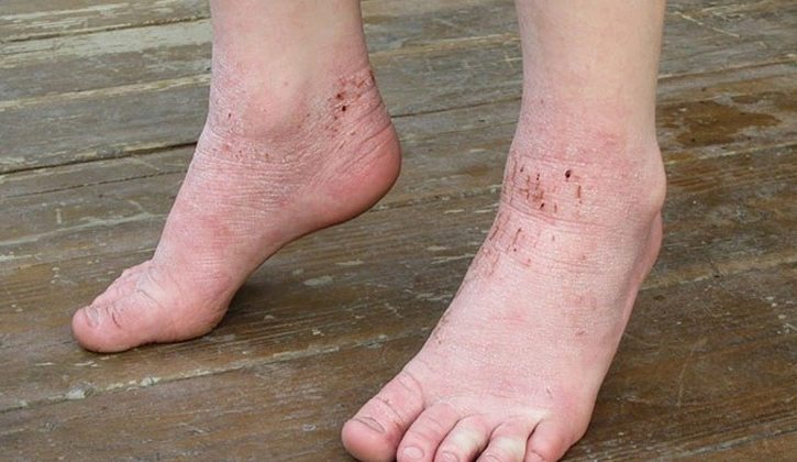 Viêm da cơ địa ở chân (hay viêm da tiết bã) là bệnh da liễu mãn tính