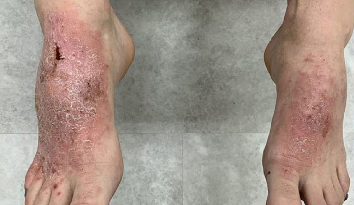 Viêm da cơ địa ở chân có thể gây nhiễm trùng da