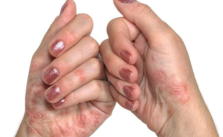 Hình ảnh viêm da cơ địa ở lòng bàn tay và ngón tay