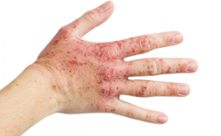 Hình ảnh mô tả bệnh viêm da cơ địa ở tay