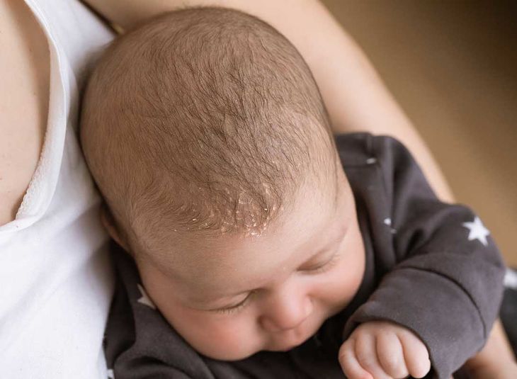 Hình ảnh viêm da tiết bã da đầu ở trẻ sơ sinh