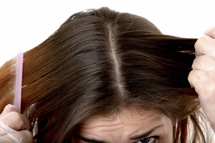 Viêm da tiết bã rụng tóc tuy là bệnh da liễu phổ biến nhưng lại thuộc nhóm bệnh lành tính
