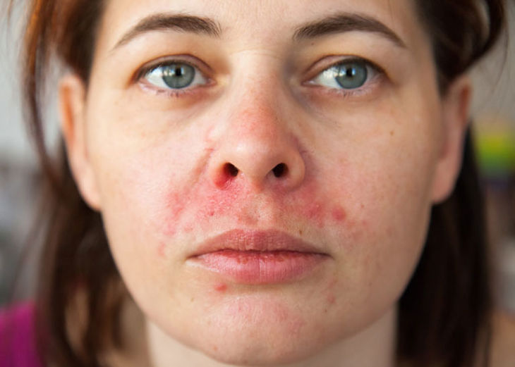 Viêm da dầu cánh mũi ảnh hưởng đến ngoại hình, tâm lý của người bệnh