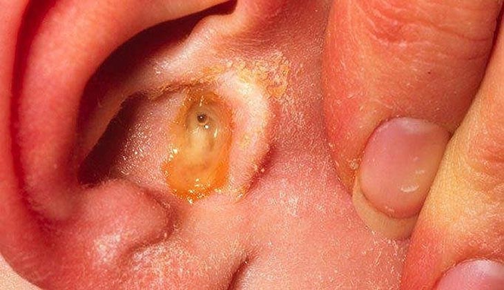 Dịch mủ ứ đọng lâu trong tai sẽ gây nhiều biến chứng nên cần được chích thông ra ngoài.
