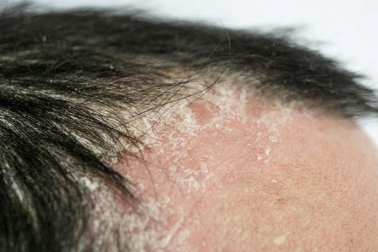 Da đầu khô, ngứa, gây bong tróc khiến người bệnh khó chịu 