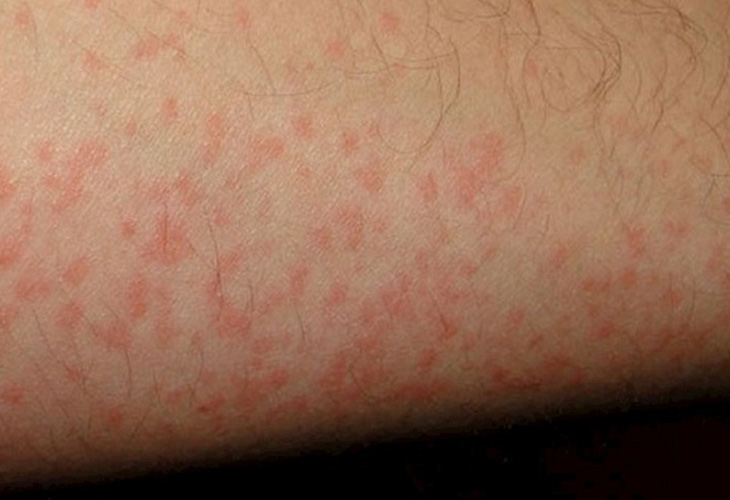Lupus ban đỏ gây các nốt mẩn đỏ trên da nhưng không ngứa