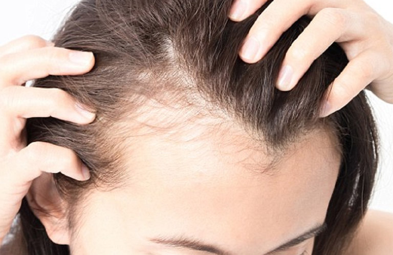 Da đầu ngứa tóc rụng nhiều là tình trạng phổ biến, xảy ra ở mọi lứa tuổi